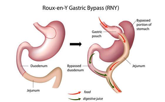 roux-en-y gastric bypass